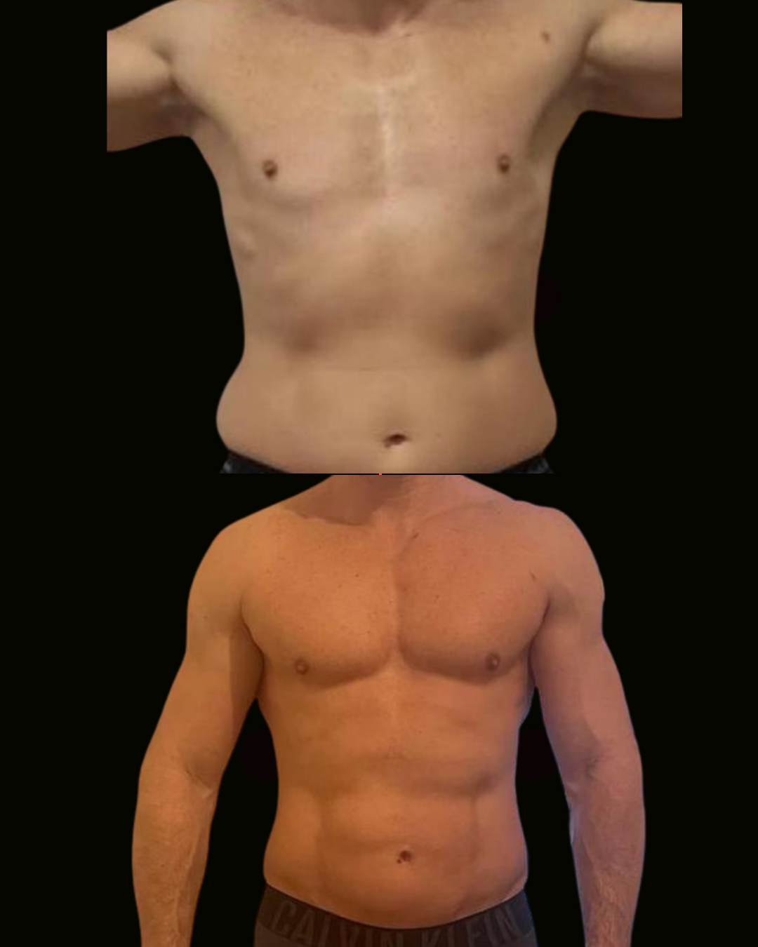 Registro autorizado de paciente do Dr. Daniel Botelho · Lipo HD masculina