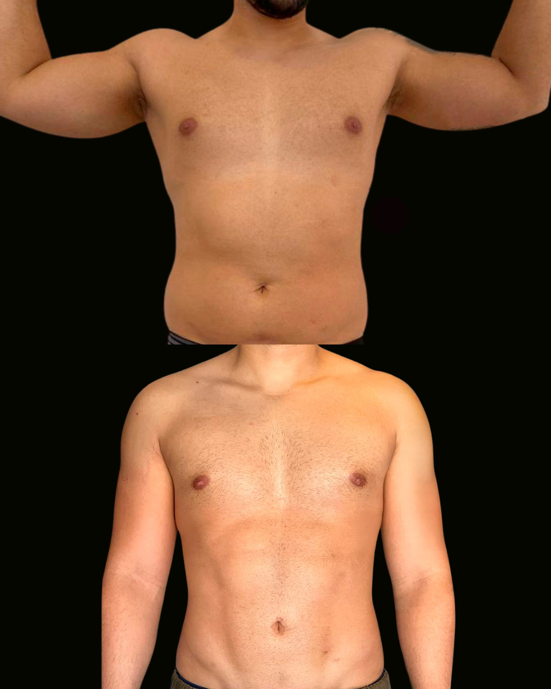 Registro autorizado de paciente do Dr. Daniel Botelho · Lipo HD masculina