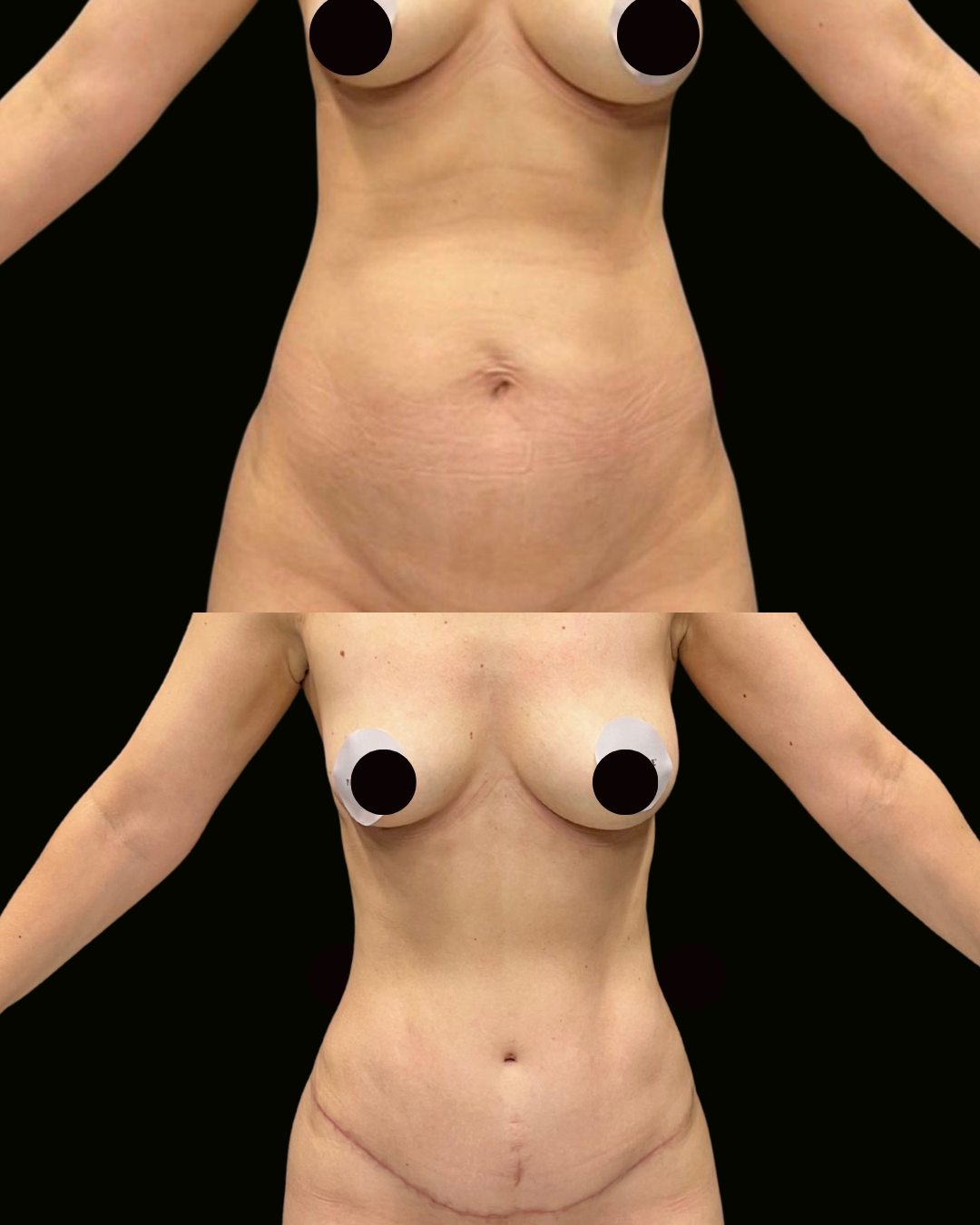 Registro autorizado de paciente do Dr. Daniel Botelho — Lipoabdominoplastia