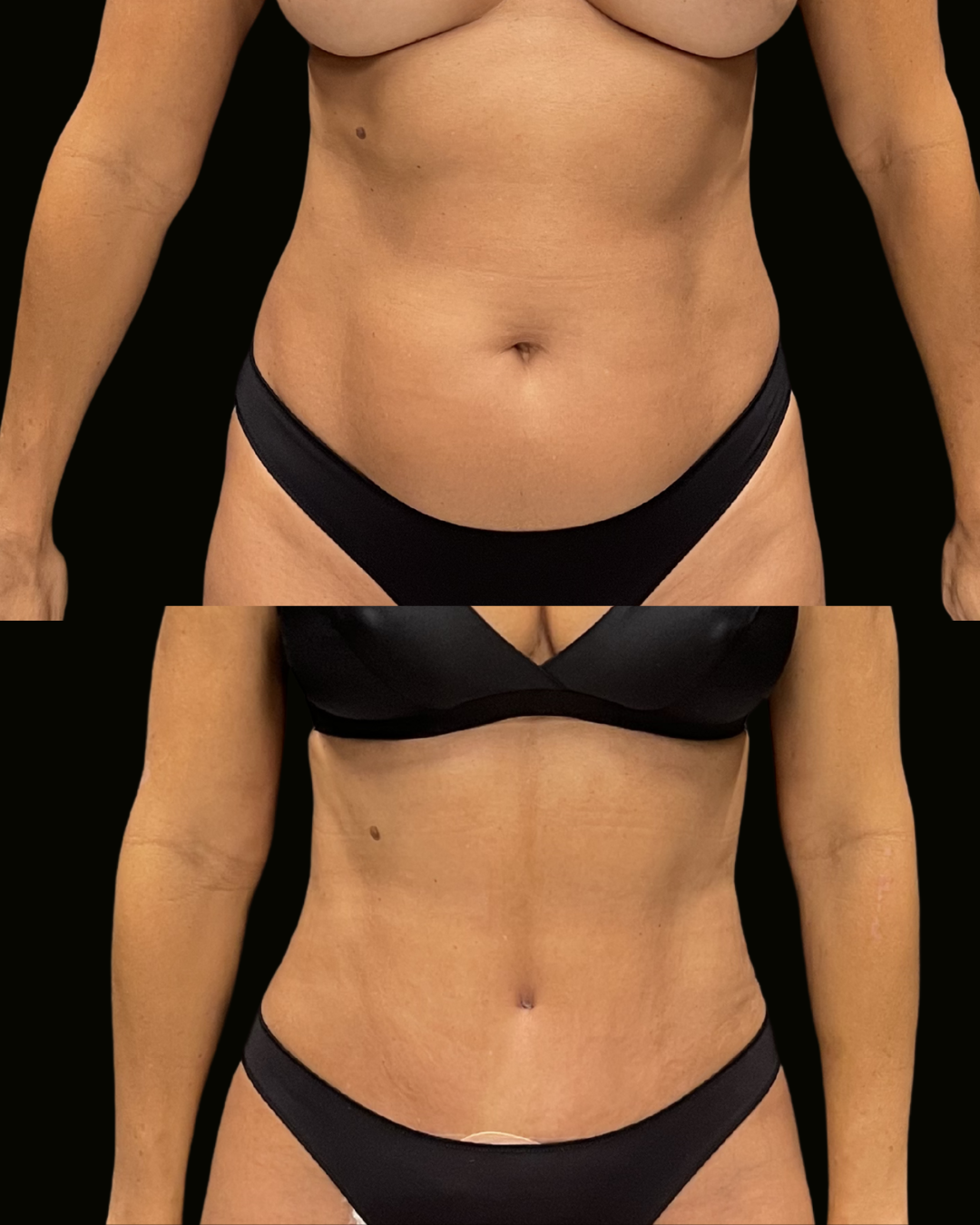 Paciente do Dr. Daniel Botelho submetida a lipoaspiração com abdominoplastia, registro divulgado com autorização por escrito