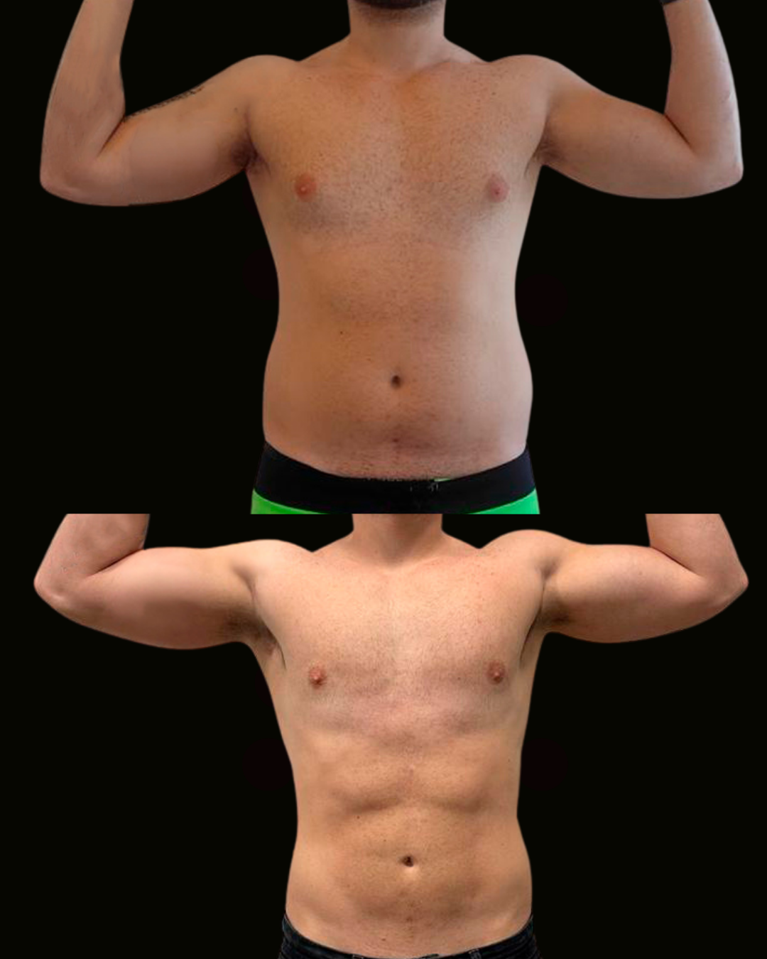 Registro autorizado de paciente do Dr. Daniel Botelho · Lipo HD masculina