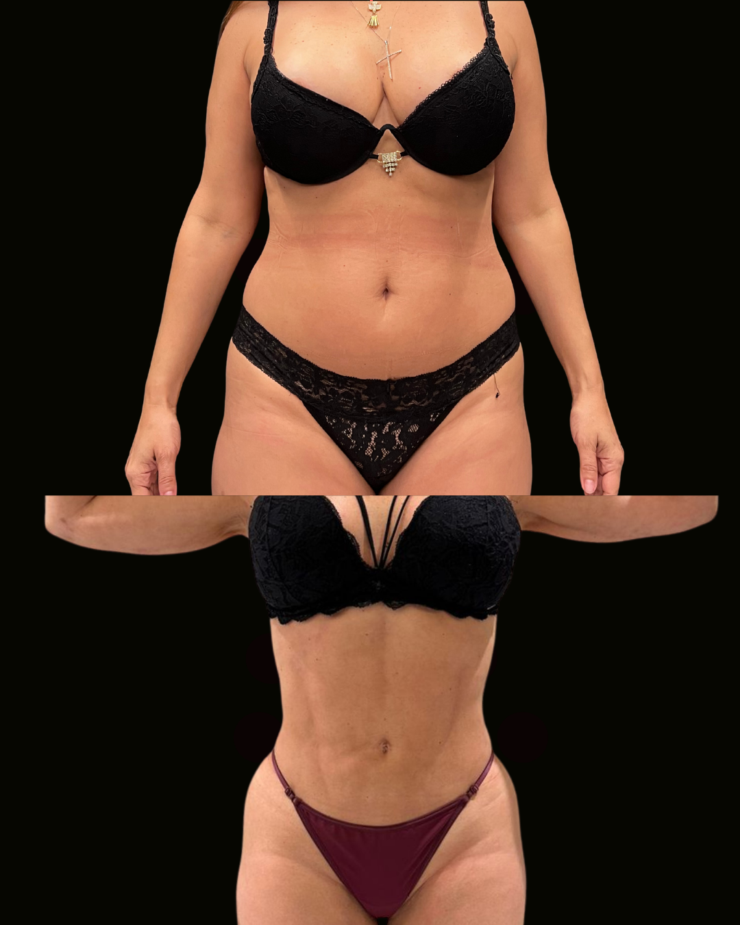 Registro autorizado de paciente submetida a Lipo HD feminina