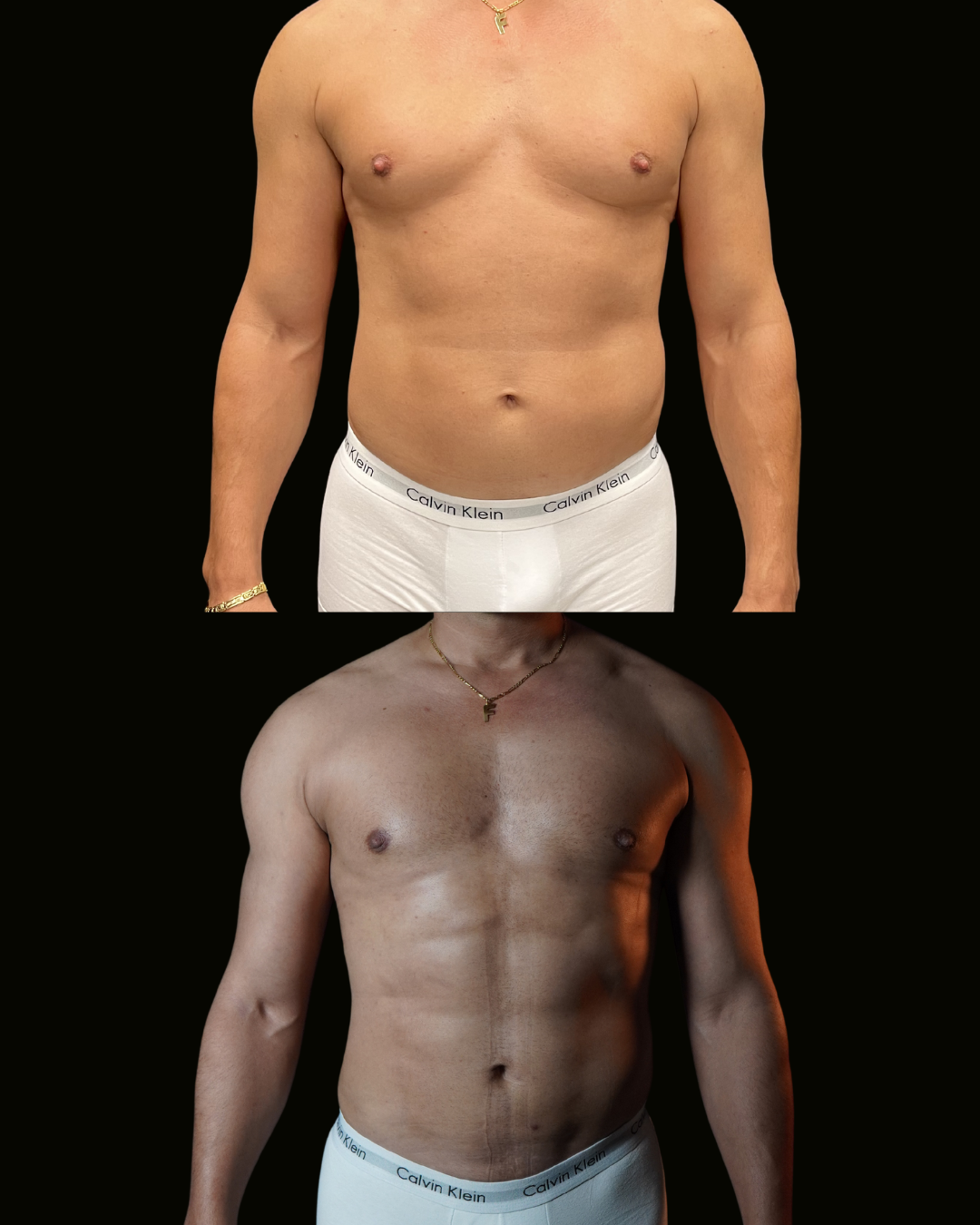 Paciente do Dr. Daniel Botelho submetido a lipo HD masculina, registro divulgado com autorização por escrito