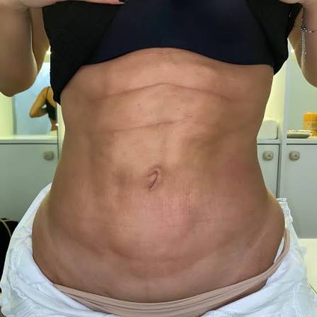 Pele com mobilidade reduzida e aderências após a lipoaspiração